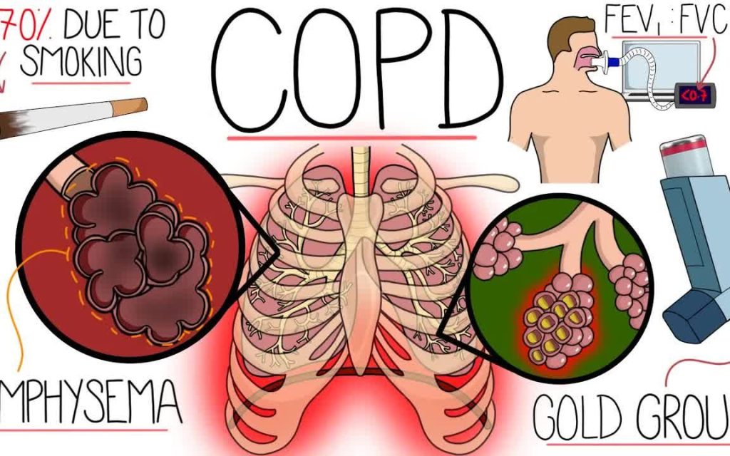 For chronic respiratory diseases such as asthma, bronchiectasis, and COPD, nebulization can do this！