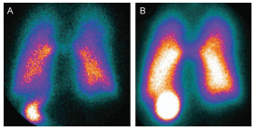 Comparison of lung deposition rate between mesh nebulizer and jet nebulizer during NIV